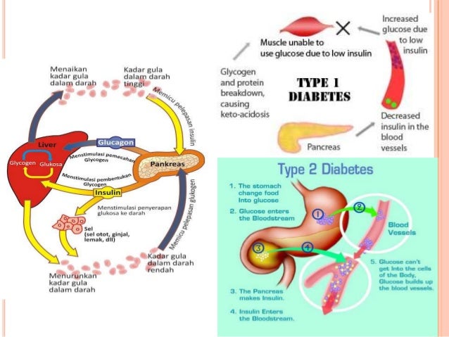 ketoasidosis diabetikum